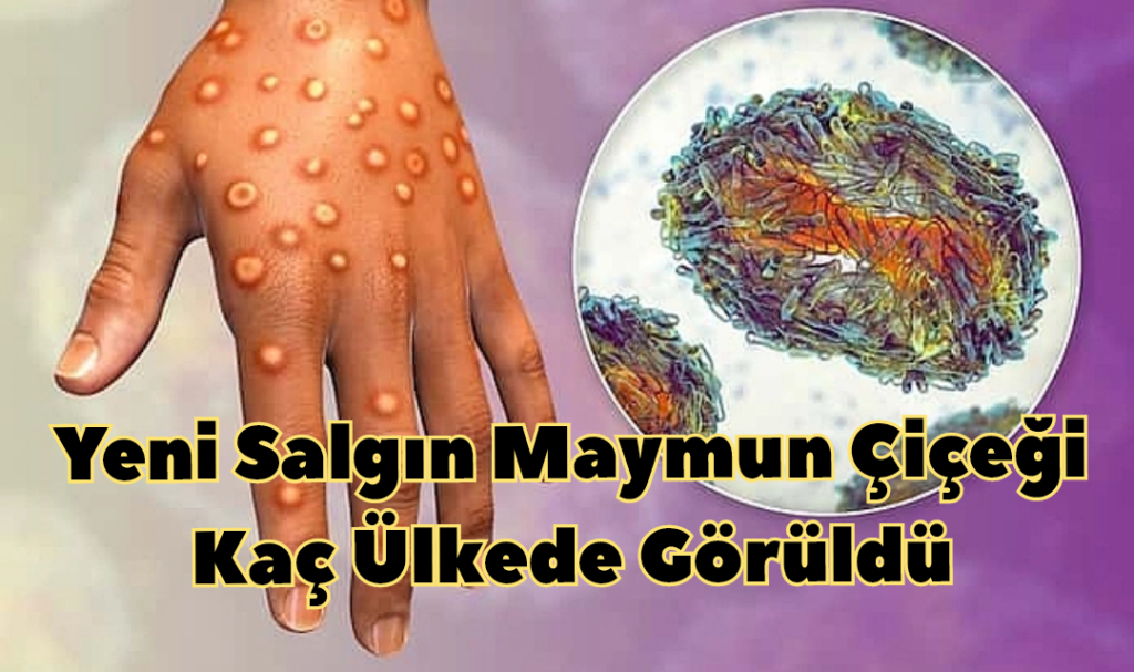 Yeni Salgın Maymun Çiçeği  Kaç Ülkede Görüldü