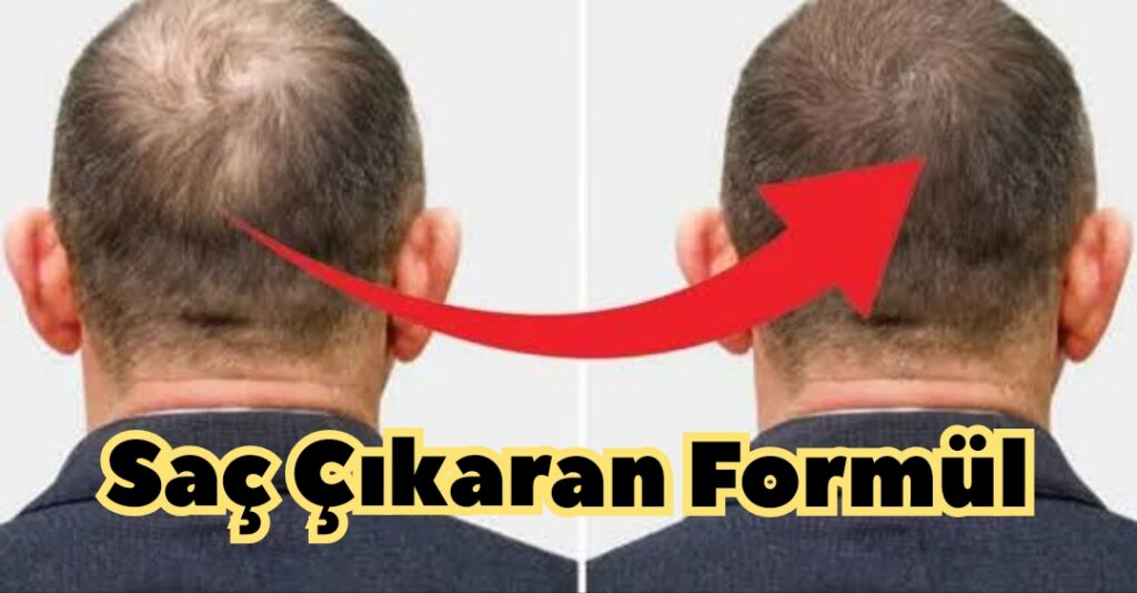 Saç Çıkaran Formül Kel Bölgelerde Saç Çıkarıyor